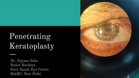 Penetrating Keratoplasty