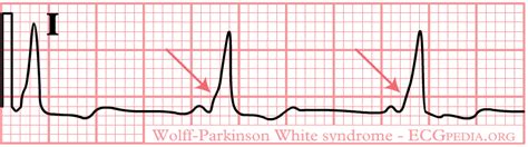 Wolff-Parkinson-White syndrome EKG - wikidoc