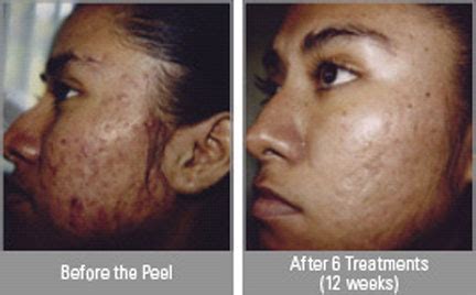 Post Inflammatory Hyperpigmentation – Pictures, Treatment, Causes