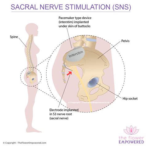 Surgical Treatments for Fecal Incontinence