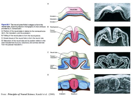 DA: Neural Tube Defects Flashcards | Quizlet
