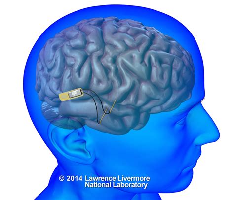 A neural device to restore memory | KurzweilAI