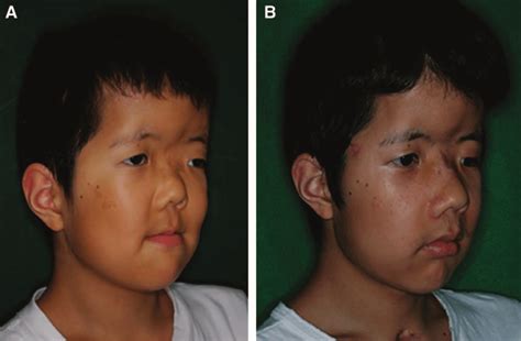 a 15-year-old boy with Pfeiffer syndrome. a, Preoperative view. Class...