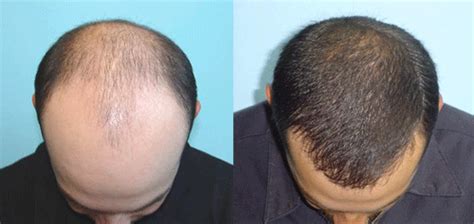 Hair transplant surgery is the nastiest looking surgery ever... (pics ...