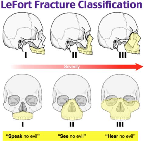 emDOCs.net – Emergency Medicine EducationEM@3AM: Le Fort Fractures ...