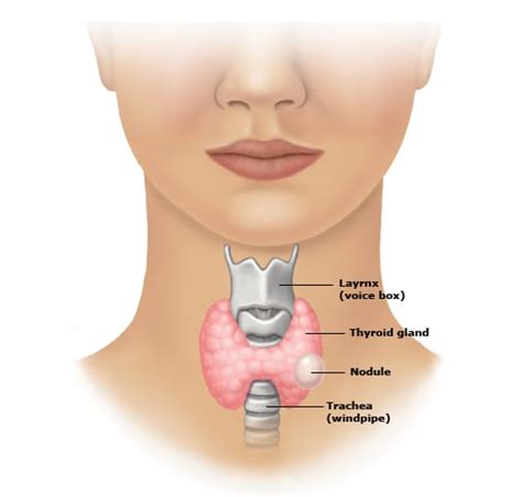 Medical Compass: Evaluating thyroid nodules | TBR News Media