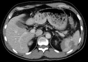 Ruptured Spleen - Physiopedia