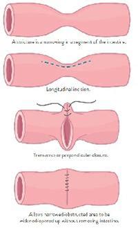 Strictureplasty | Crohn's & Colitis Foundation