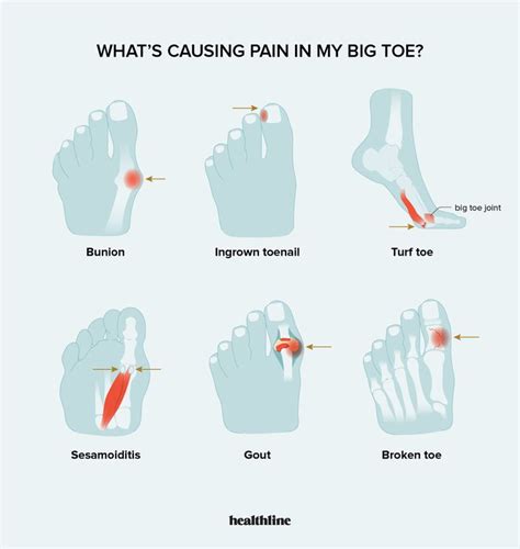 Causes of Sharp Pain in Big Toe and When to Contact a Doctor | Big toe ...