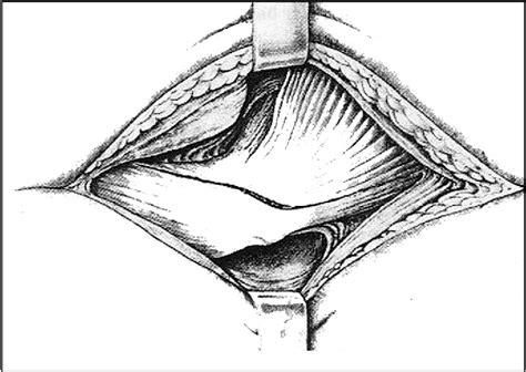 Figure 1 from Variations in the anterolateral approach to the hip | Semantic Scholar