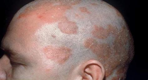 eczema scrotum - pictures, photos