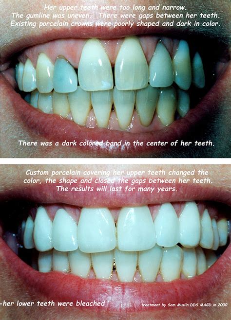 Tetracycline Stained Teeth