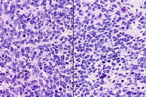 Types Of Cancer Cells Under Microscope