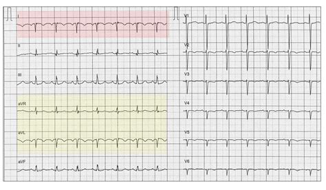 Dextrocardia and reversed limb leads - Resources