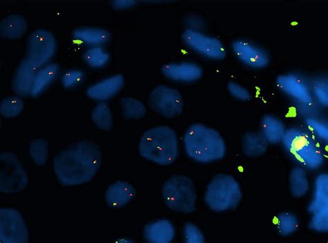 ALK in Lung Cancer: ESMO Biomarker Factsheet | OncologyPRO