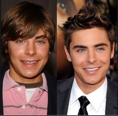 Zac Efron had some spacing between his upper centrals, but with the wonderful works of braces ...