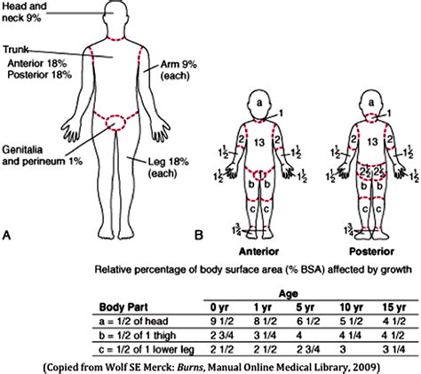 Burns in children: the importance of assessing for non-accidental ...