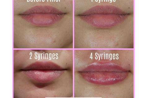 One Two or Four Syringes Filler Lip Results – Charmed Medispa