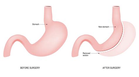 Gastric sleeve surgery: What you need to know