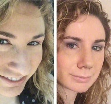 Bulbous Nose Contouring Before And After » Rhinoplasty: Cost, Pics, Reviews, Q&A