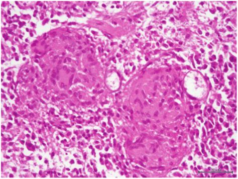 Microscopic image (H&E) revealed multinucleated giant cell; formation... | Download Scientific ...