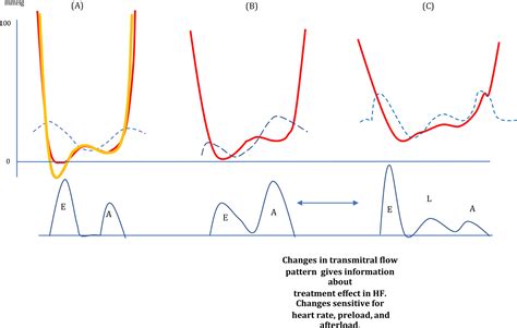 Diastolic function assessment by echocardiography: A practical manual for clinical use and ...