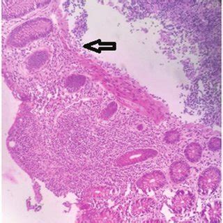 Photomicrograph showing lymphoid aggregates in the mucosa and submucosa... | Download Scientific ...