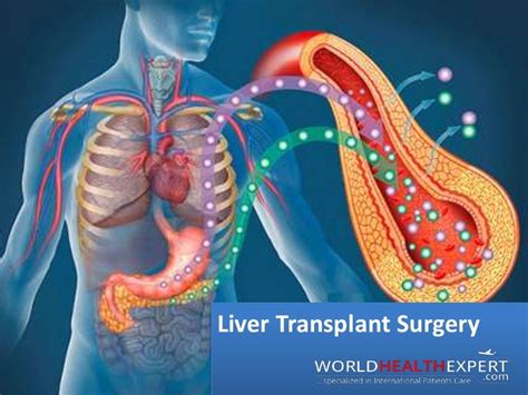 Liver transplant surgery and Procedure