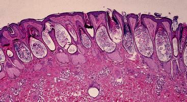 Congenital and Hereditary Skin Diseases | Veterian Key