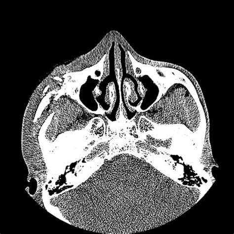 ZMC Fracture - Skull and Face - embodi3D.com