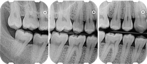 31: Radiographic Aids in the Diagnosis of Periodontal Disease | Pocket ...