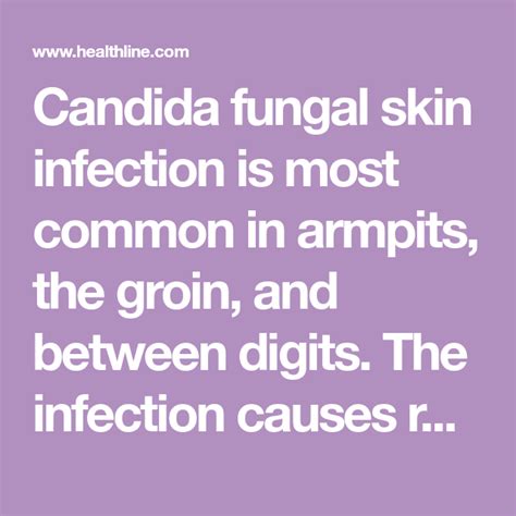 Candida fungal skin infection is most common in armpits, the groin, and ...