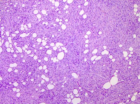 Pathology Outlines - Dermatofibrosarcoma protuberans (DFSP)