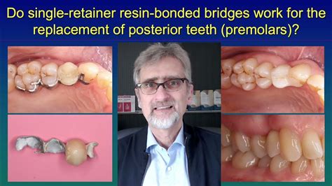 Do single-retainer resin-bonded bridges work for the replacement of posterior teeth? - YouTube