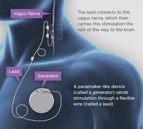 Vagus Nerve Stimulation - The Defeating Epilepsy Foundation