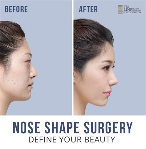 Aquiline Nose Surgery, Nose Shape Surgery In Korea | Nose types, Nose shapes, Nose reshaping