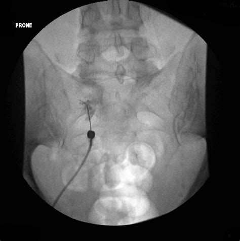 S1 nerve root injection (fluoroscopy) | Image | Radiopaedia.org