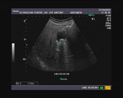 Ultrasound imaging: Gall bladder calculi- Ultrasound video clips: