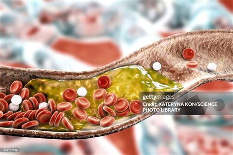 Atheromatous Plaque In Artery Illustration High-Res Vector Graphic ...