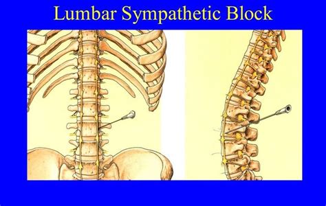 The lumbar sympathetic block involves placing a local anesthetic agent near sympathetic nerves ...