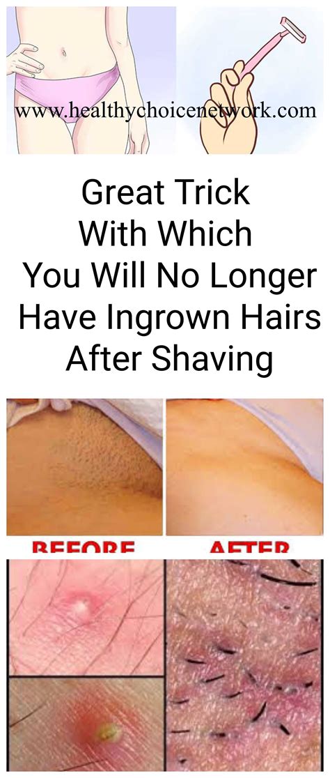 #trick #ingrown #hair #razor #shaving #beauty #problem | Shaving alternatives, Health and beauty ...