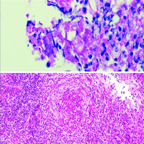 The histopathologic findings were marked active colitis with ...