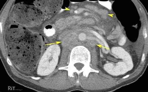 RiT radiology: Retroperitoneal Lymphadenopathy