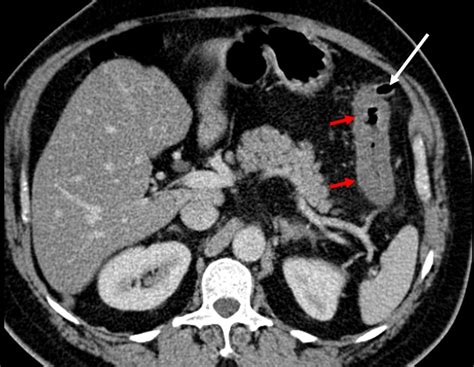 Acute diverticulitis – Radiology Cases