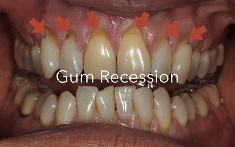 What Causes Gum Recession? - Causes, Prevention, and Treatments