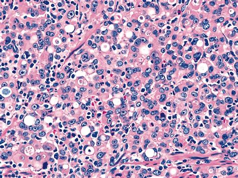 Pathology Outlines - Adenocarcinoma of GE junction