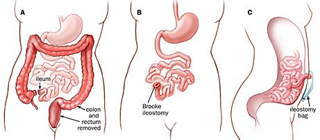 Lynch Syndrome Treatment | Johns Hopkins Medicine