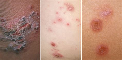 Impetigo Rash in Babies: Symptoms, Causes & Treatment