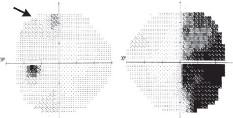 Topical Diagnosis of Optic Chiasmal and Retrochiasmal Lesions | Ento Key