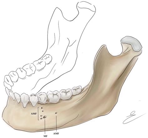 Mental Foramen